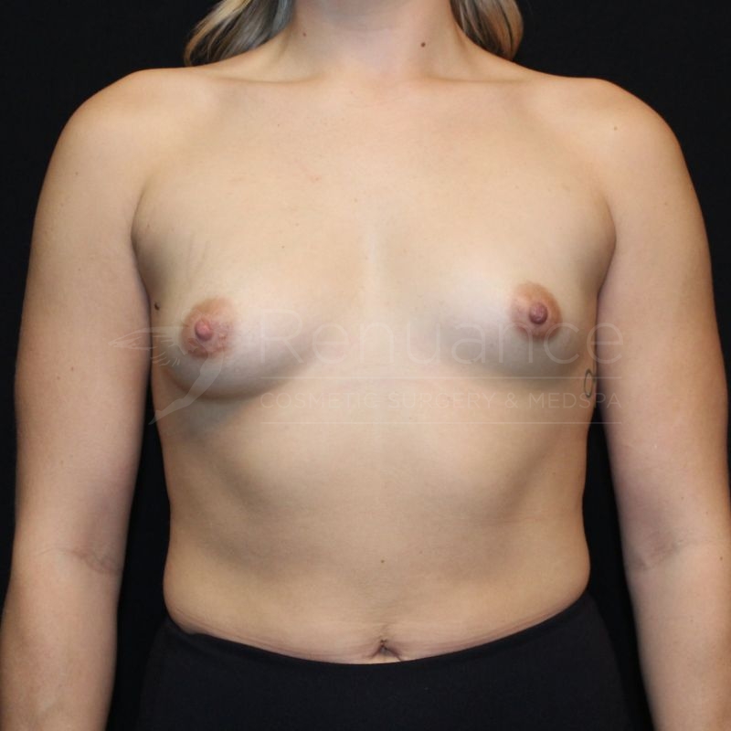 Case--3498P35 | Before Breast Augmentation