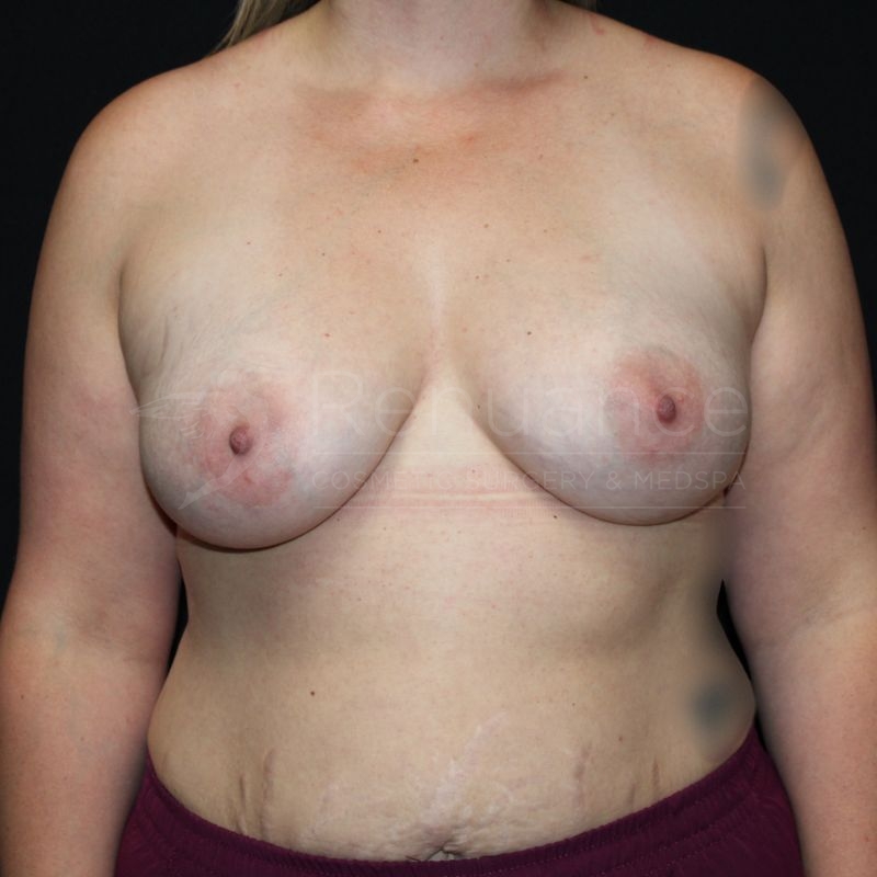 Case--8883F39 | After Breast Augmentation