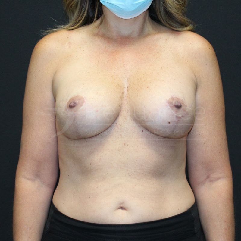Case--2295P5 | After Breast Augmentation with Lift