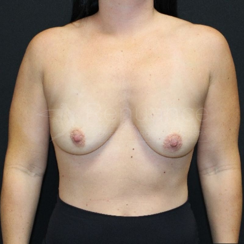 Case--5891P10 | Before Breast Augmentation with Lift