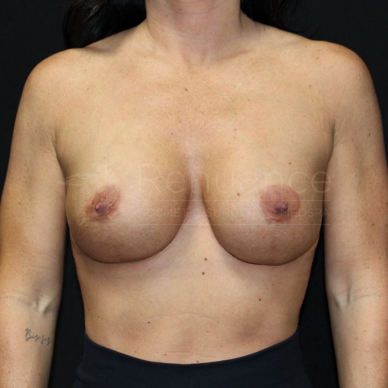 Case--5891P10 | After Breast Augmentation with Lift