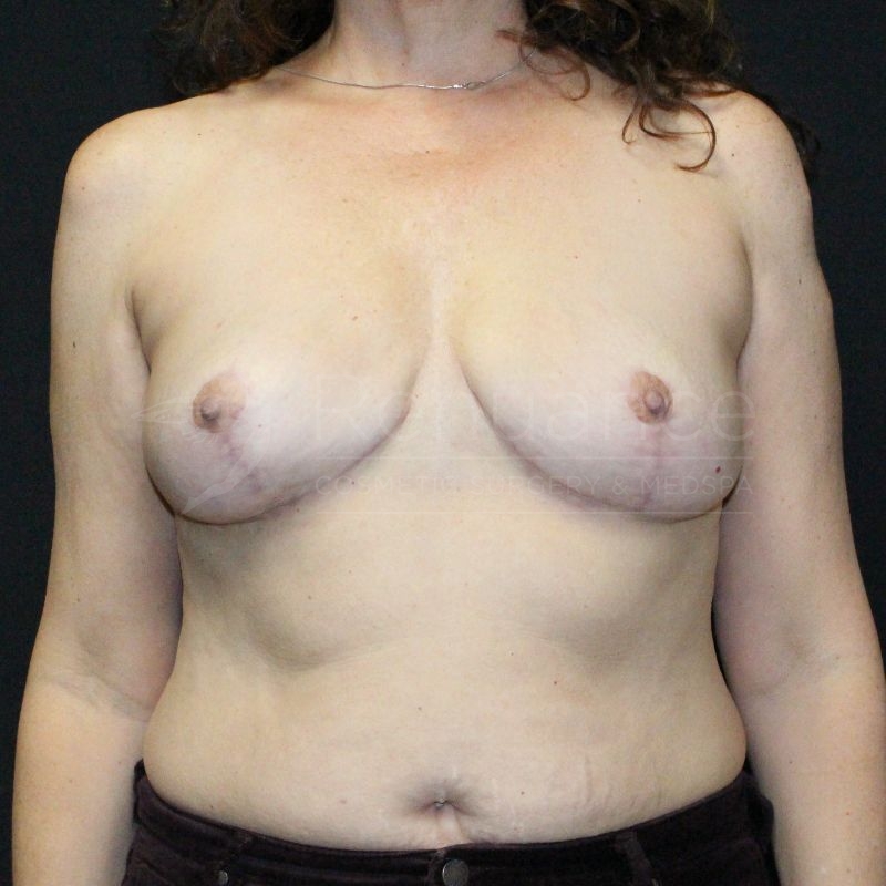 Case--3803P3 | After Breast Implant Removal with Breast Lift