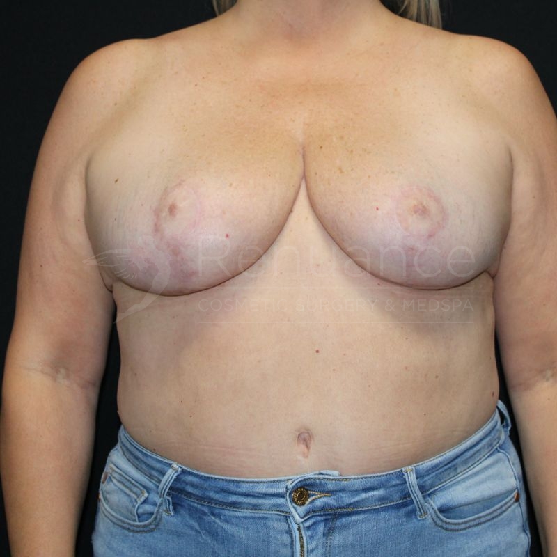 Case--6401P4 | After Breast Reduction