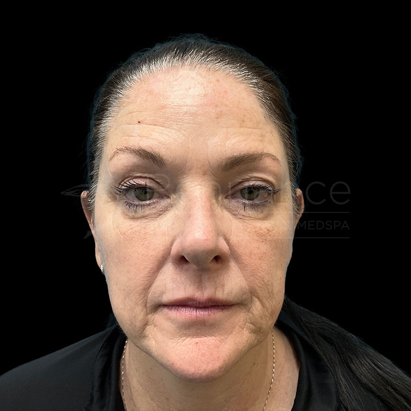 Case--3980 | Before CO2 Laser