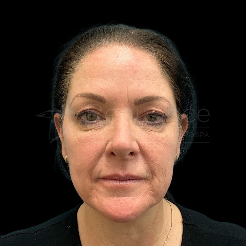 Case--3980 | After CO2 Laser