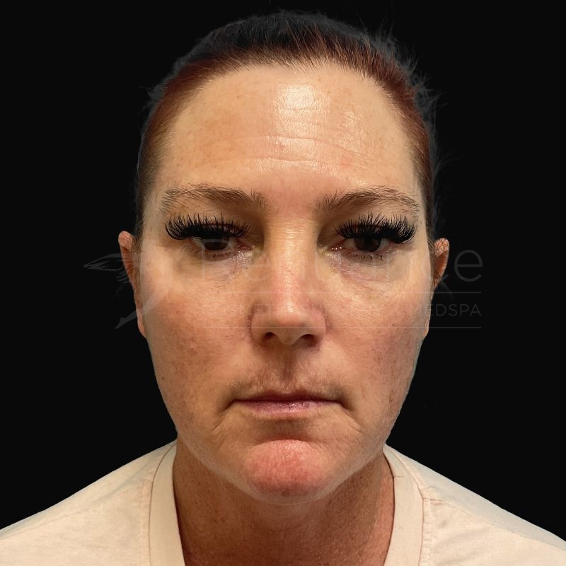 Case--8771 | Before Chelsea Delaney, RN