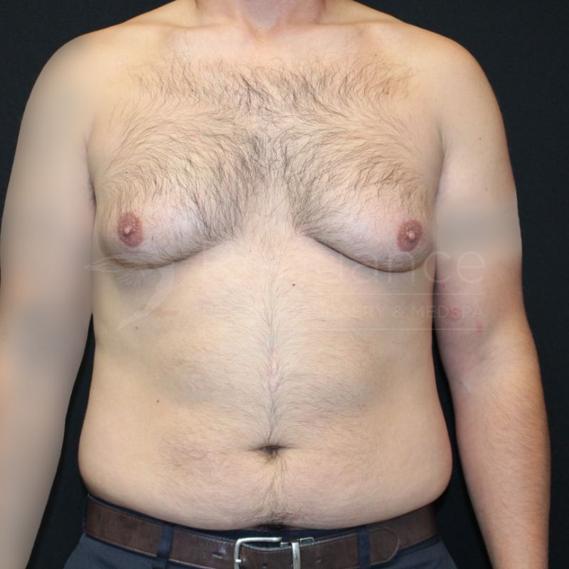 Case--5389P1 | Before Gynecomastia