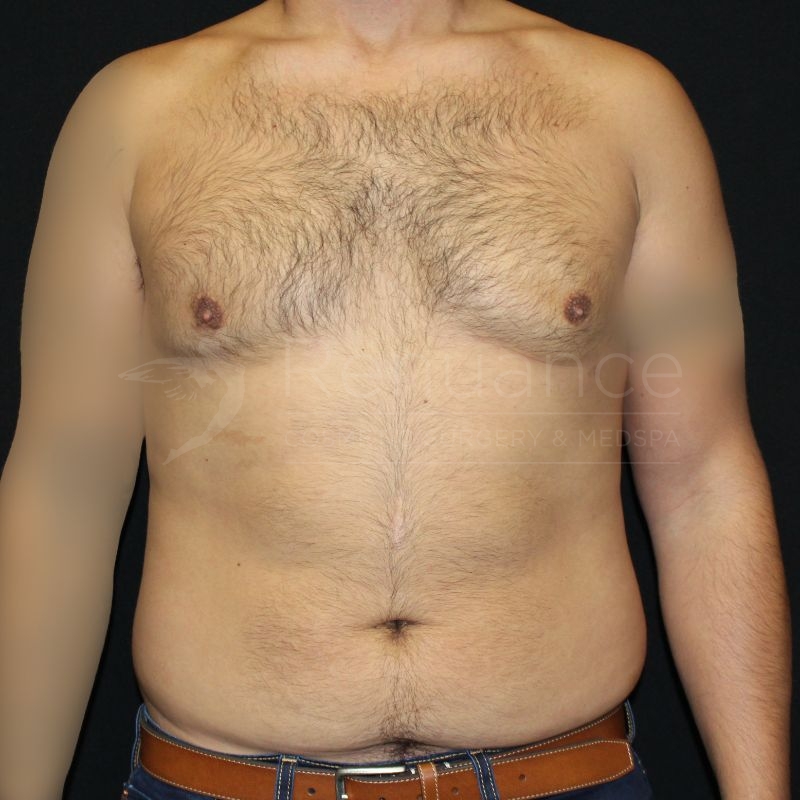 Case--5389P1 | After Gynecomastia