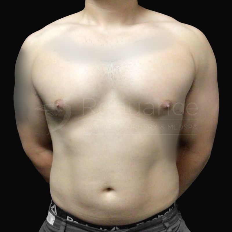 Case--5951H | Before Gynecomastia