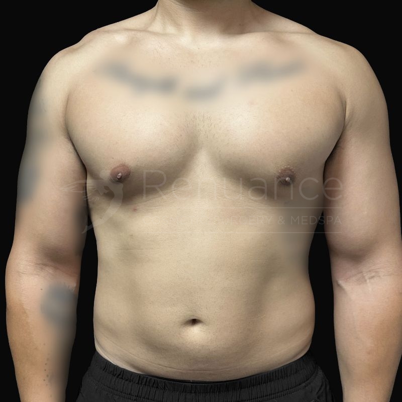 Case--5951H | After Gynecomastia
