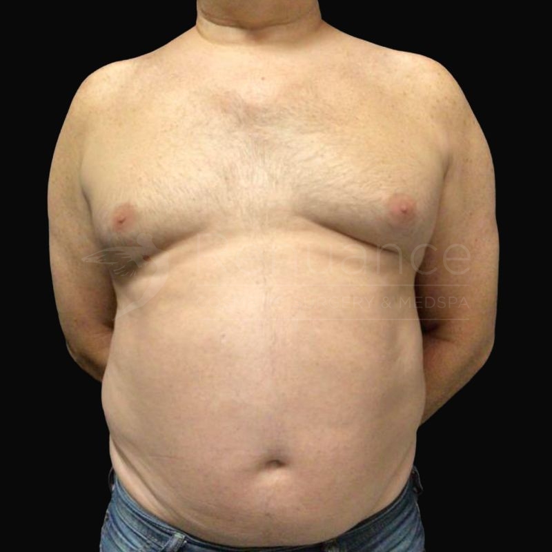 Case--9838H | Before Gynecomastia