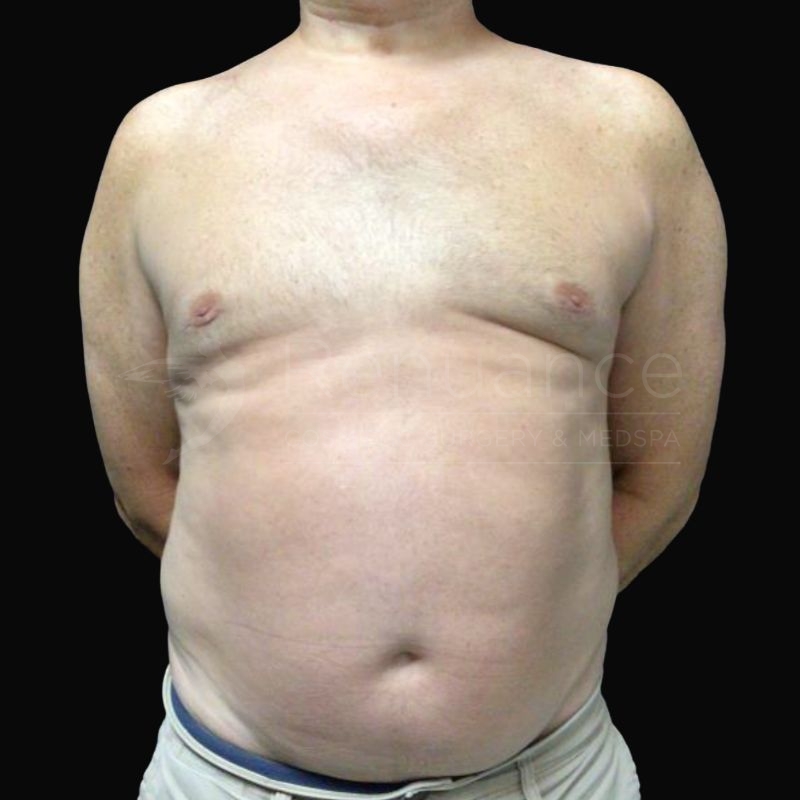 Case--9838H | After Gynecomastia