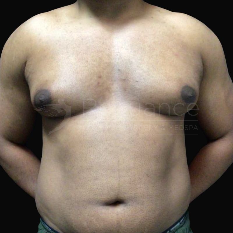 Case--8424H | Before Gynecomastia
