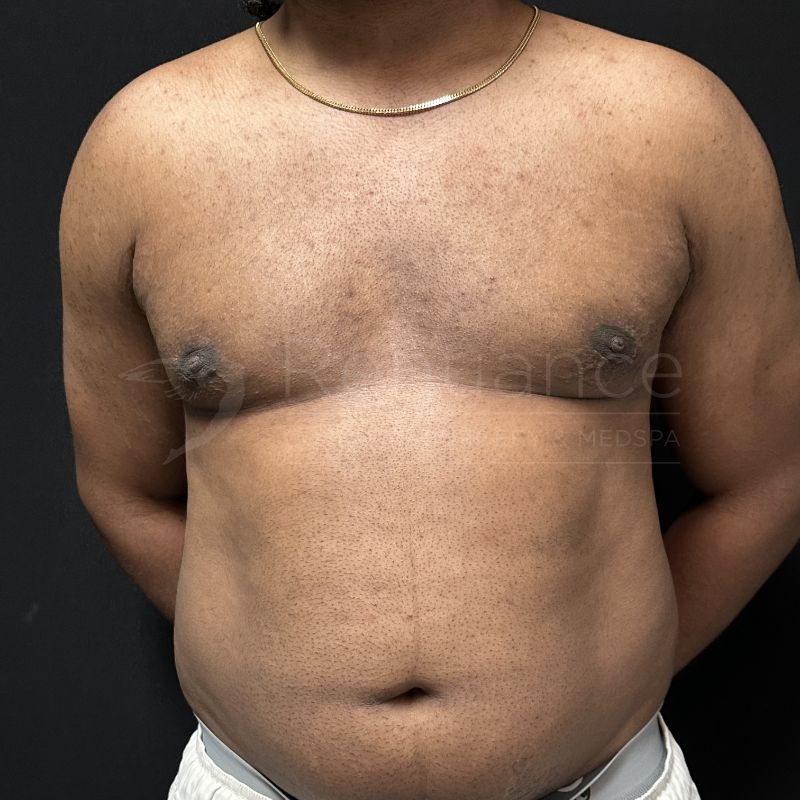 Case--8424H | After Gynecomastia