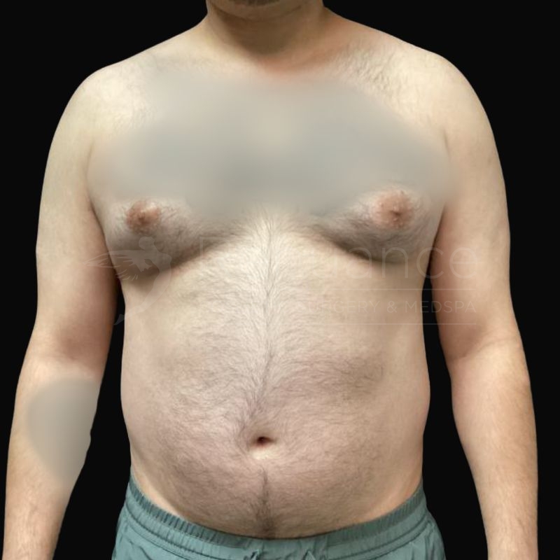 Case--9904H | Before Gynecomastia