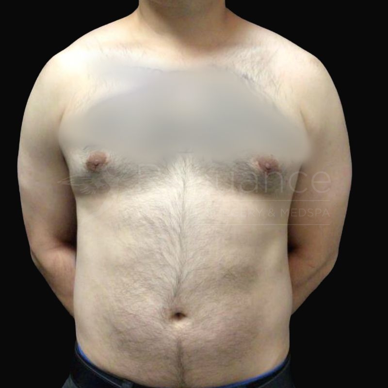 Case--9904H | After Gynecomastia