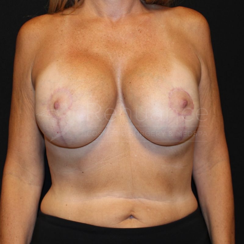Case--7850P2 | After Breast Implant Exchange