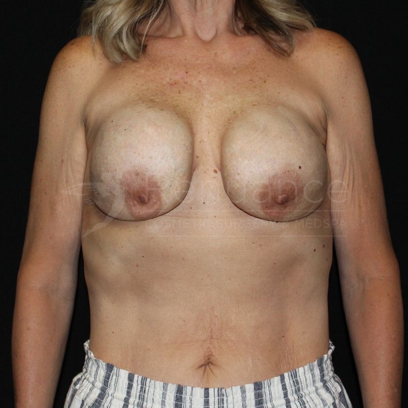 Case--3710P10 | Before Breast Implant Exchange