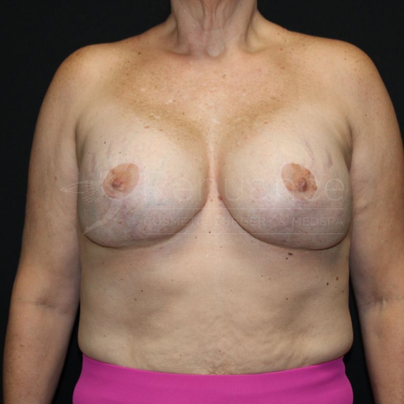Case--3710P10 | After Breast Implant Exchange