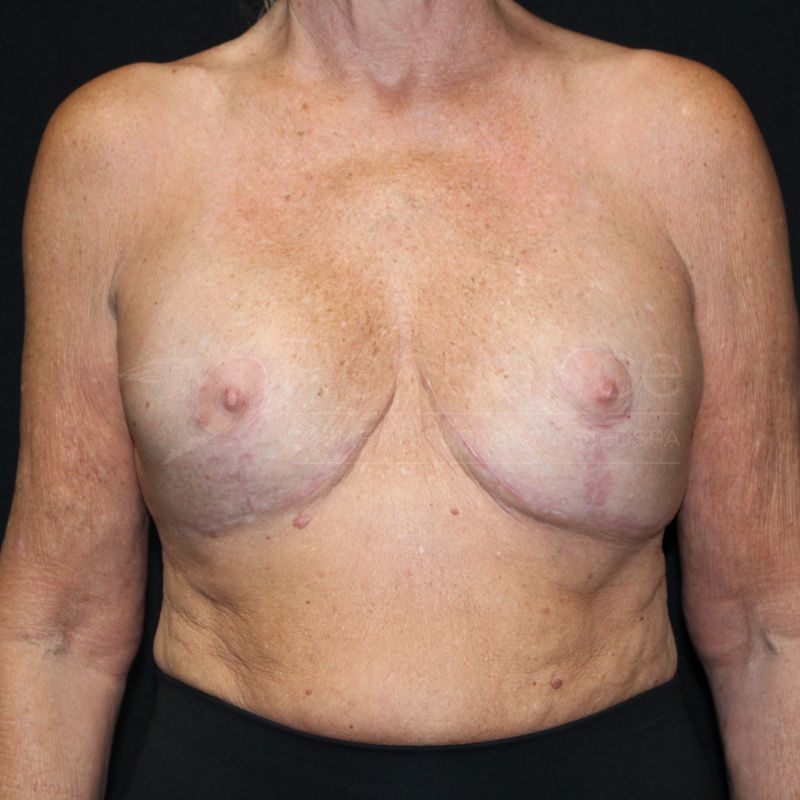 Case--7016P11 | After Breast Implant Exchange