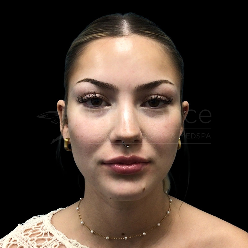 Case--5640 | After Lip Filler