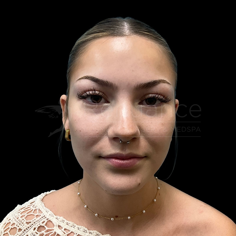 Case--5640 | Before Lip Filler