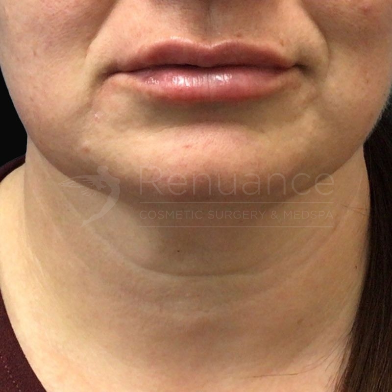Case--1586 | After Debbie Taurek, MD